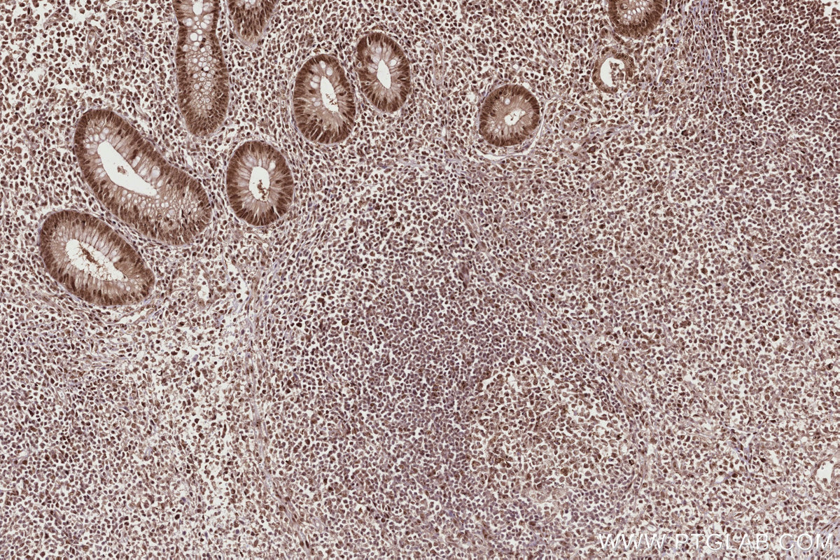 IHC staining of human appendicitis using 68583-1-Ig IHC staining of human appendicitis using 68583-1-Ig