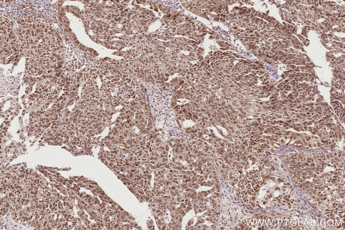 IHC staining of human ovary cancer using 68583-1-Ig IHC staining of human ovary cancer using 68583-1-Ig