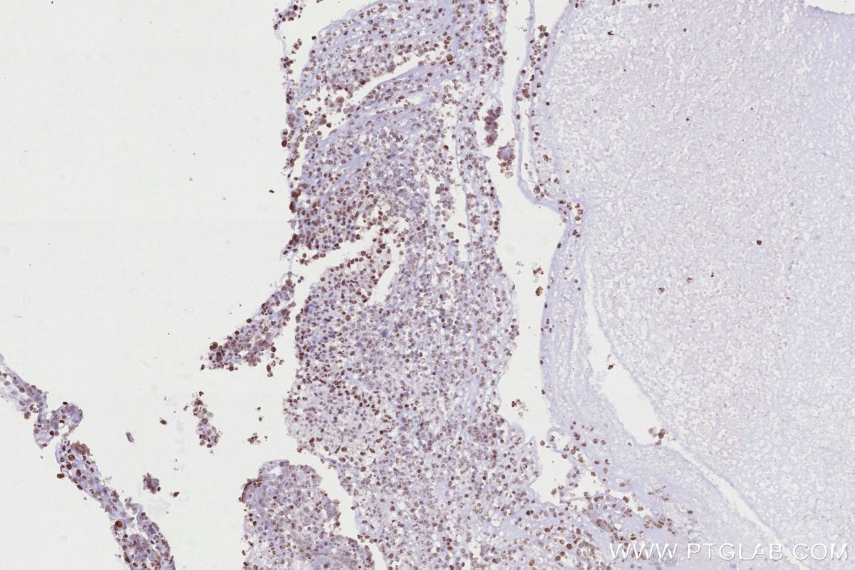 IHC staining of human ovary cancer using 68583-1-Ig IHC staining of human ovary cancer using 68583-1-Ig