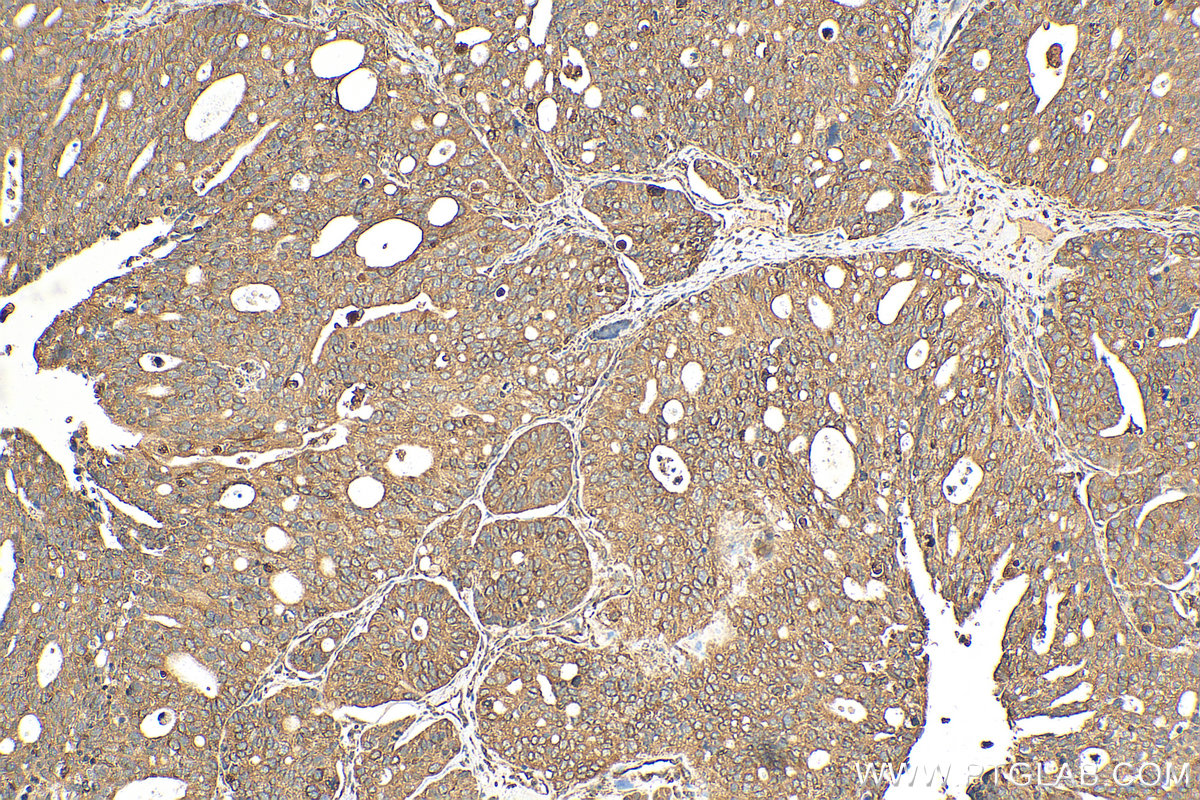 IHC staining of human ovary tumor using 10583-1-AP