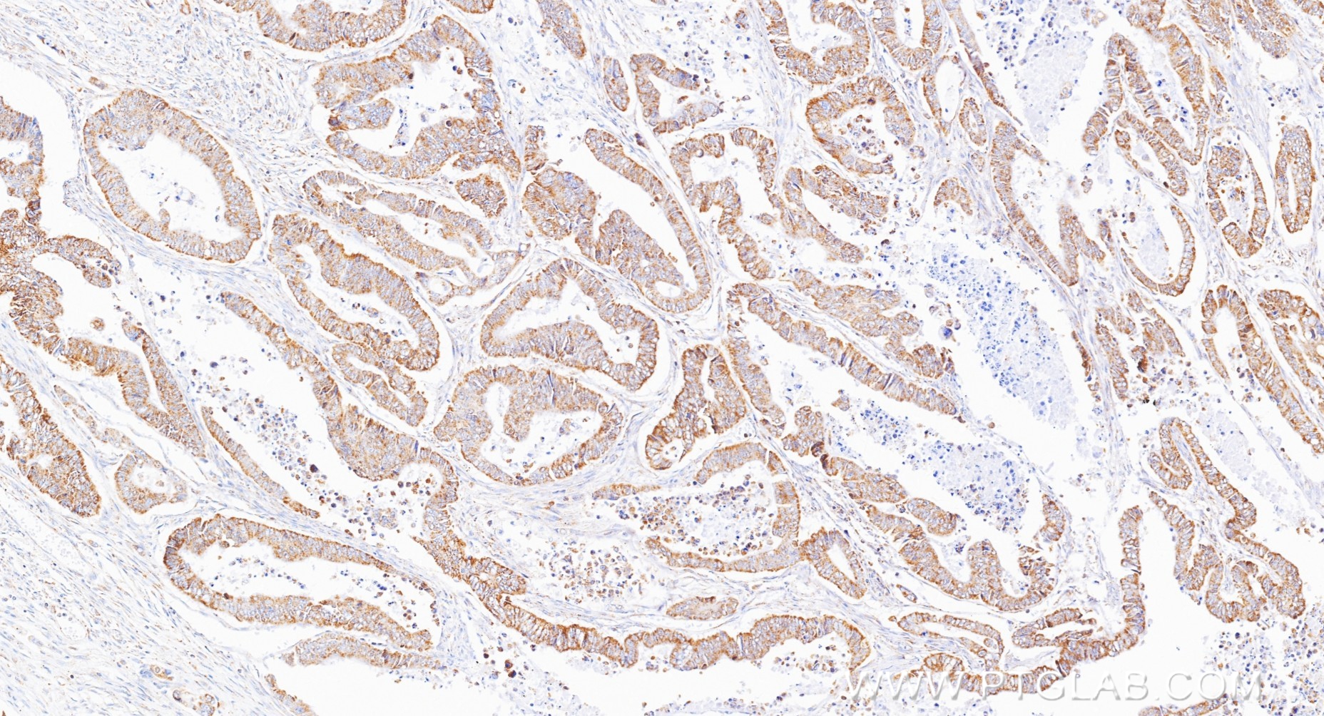 IHC staining of human colon cancer using 85634-2-RR IHC staining of human colon cancer using 85634-2-RR