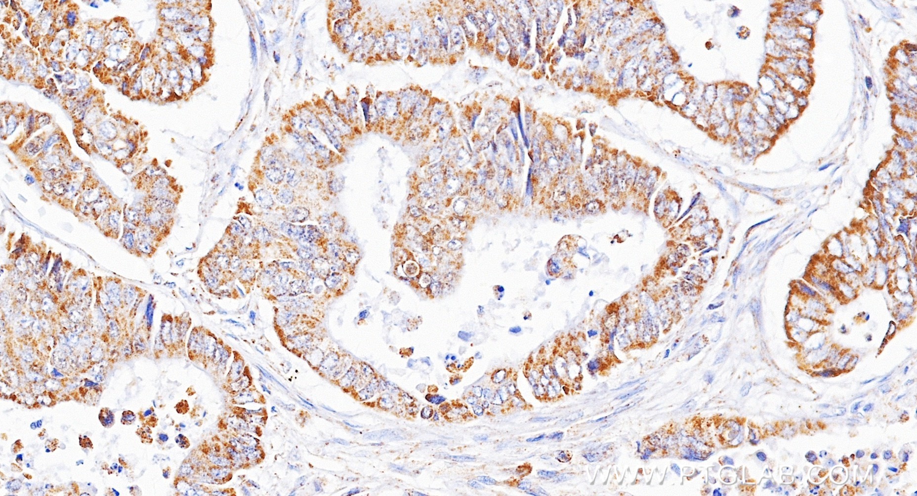 IHC staining of human colon cancer using 85634-2-RR IHC staining of human colon cancer using 85634-2-RR