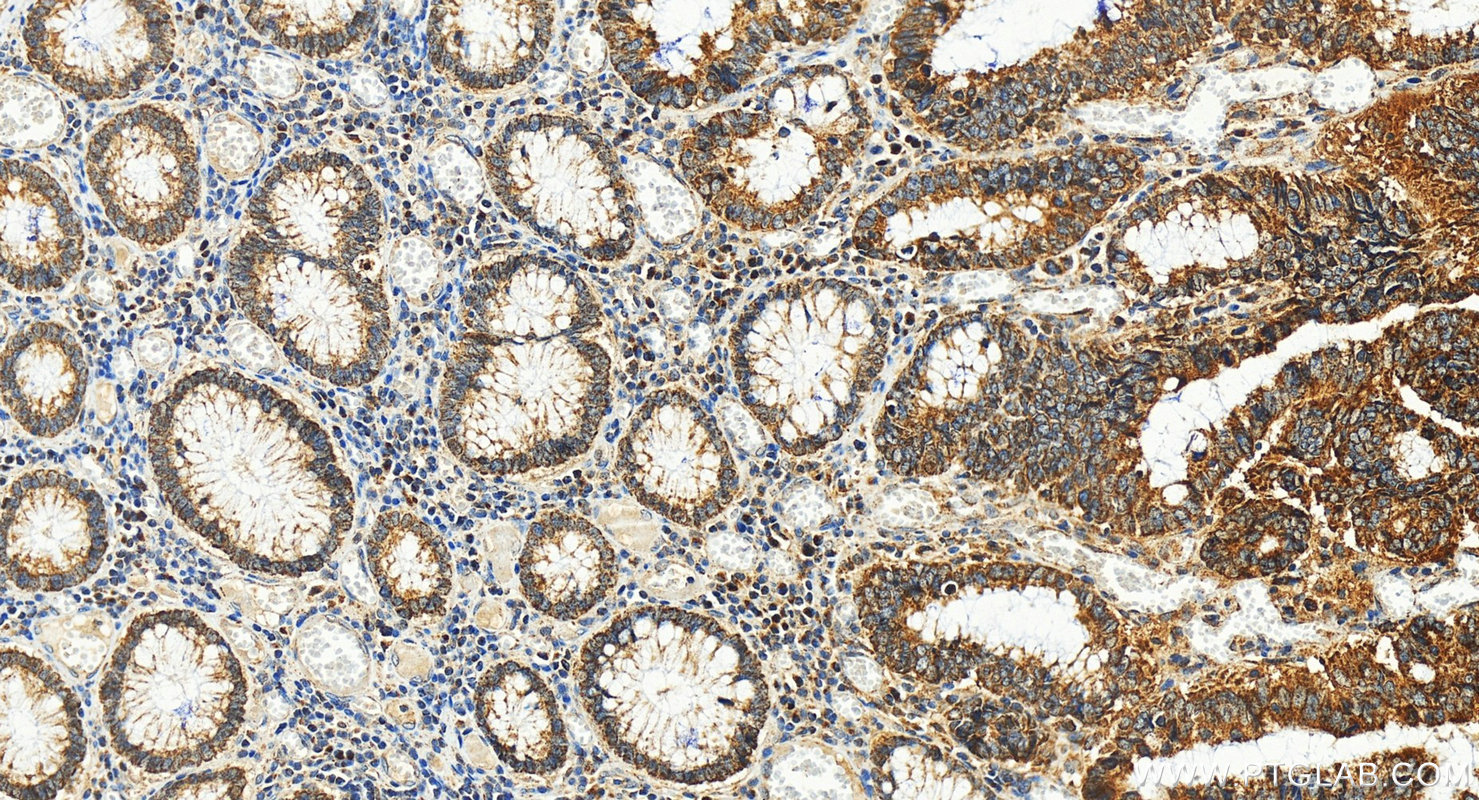 IHC staining of human colon cancer using 14355-1-AP