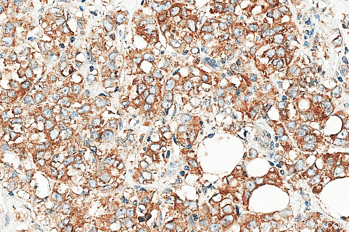 IHC staining of human breast cancer using 16442-1-AP IHC staining of human breast cancer using 16442-1-AP