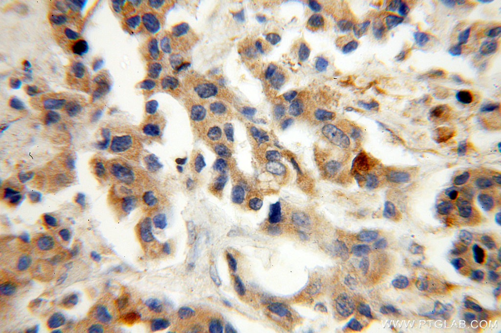 IHC staining of human breast cancer using 16442-1-AP