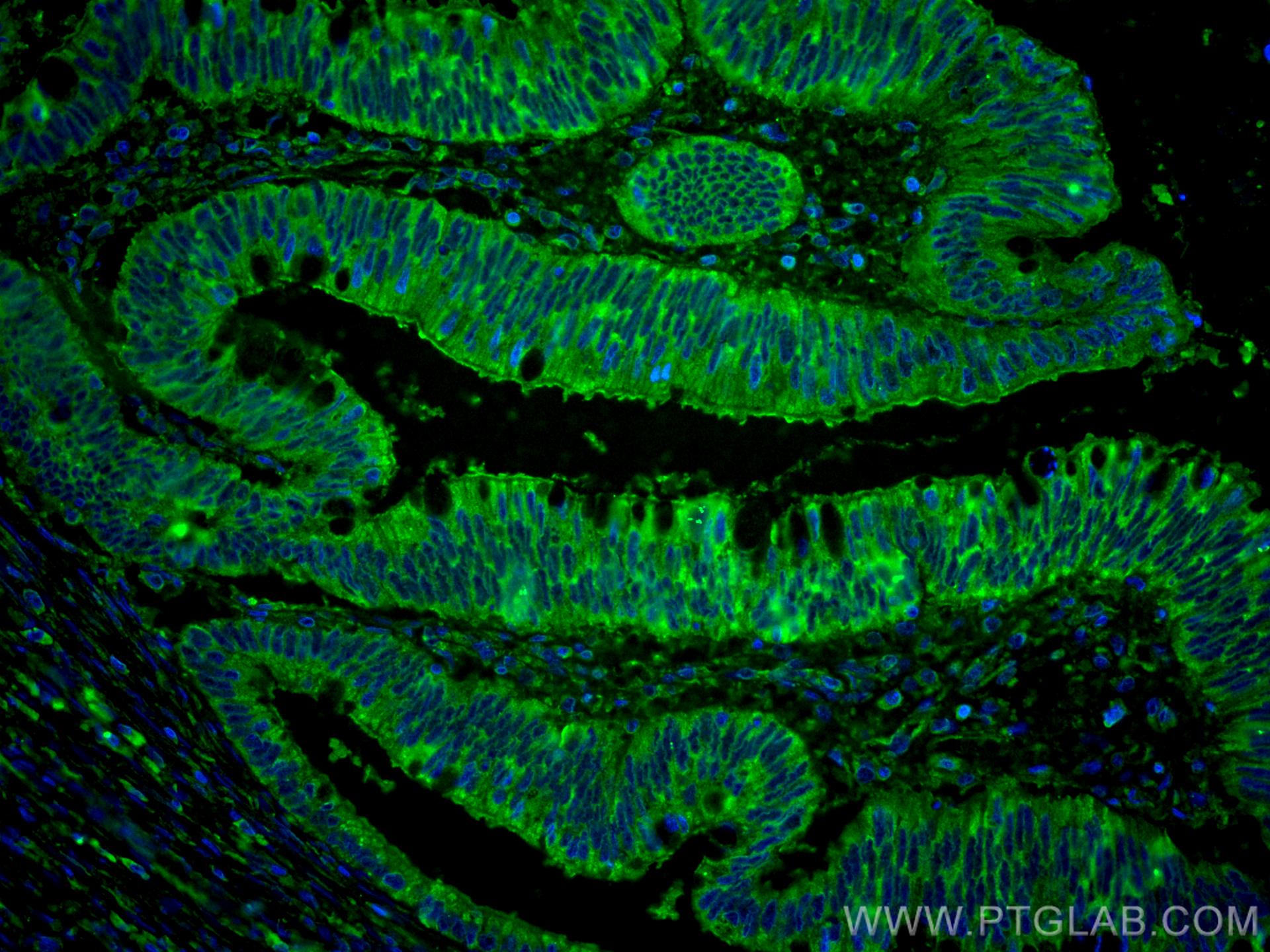 IF Staining of human colon cancer using CL488-66209