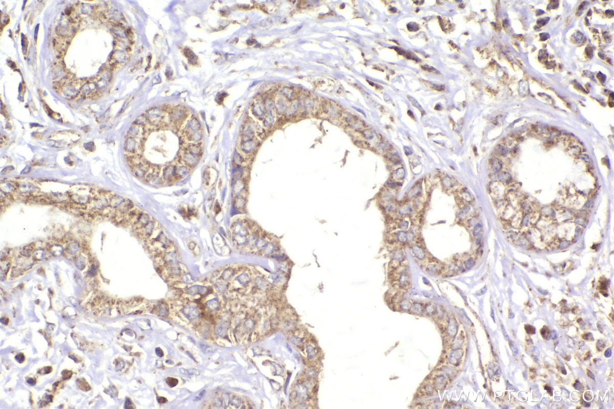 IHC staining of human pancreas cancer using 11945-1-AP