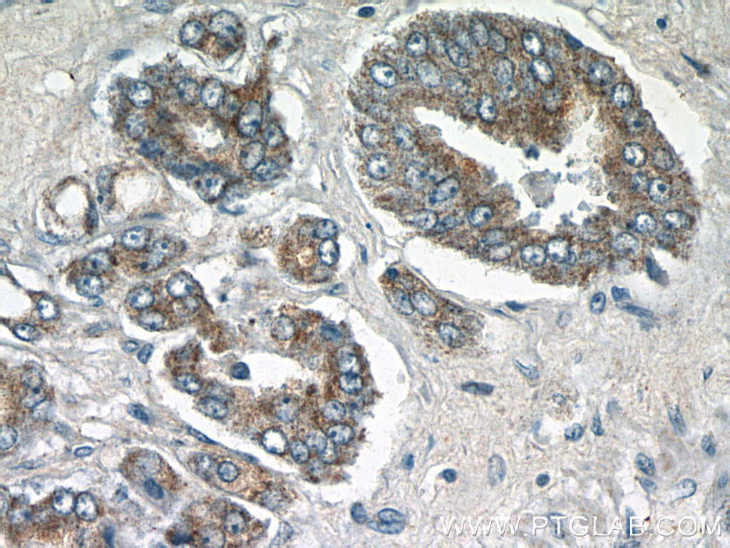 IHC staining of human prostate hyperplasia using 24274-1-AP