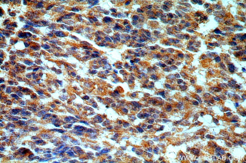 IHC staining of human gliomas using 20392-1-AP