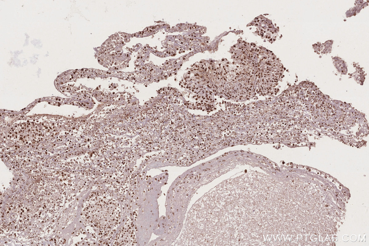 IHC staining of human ovary cancer using 14015-1-AP