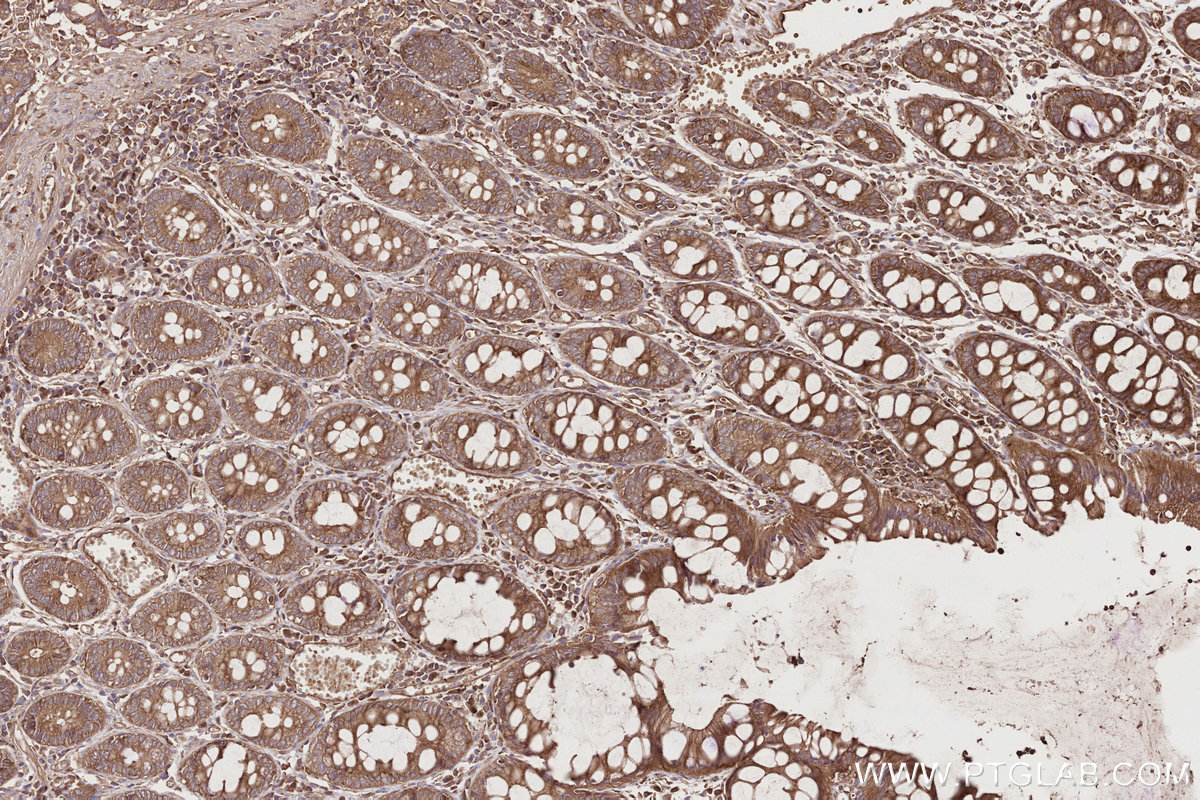 IHC staining of human rectal cancer using 12434-1-AP IHC staining of human rectal cancer using 12434-1-AP