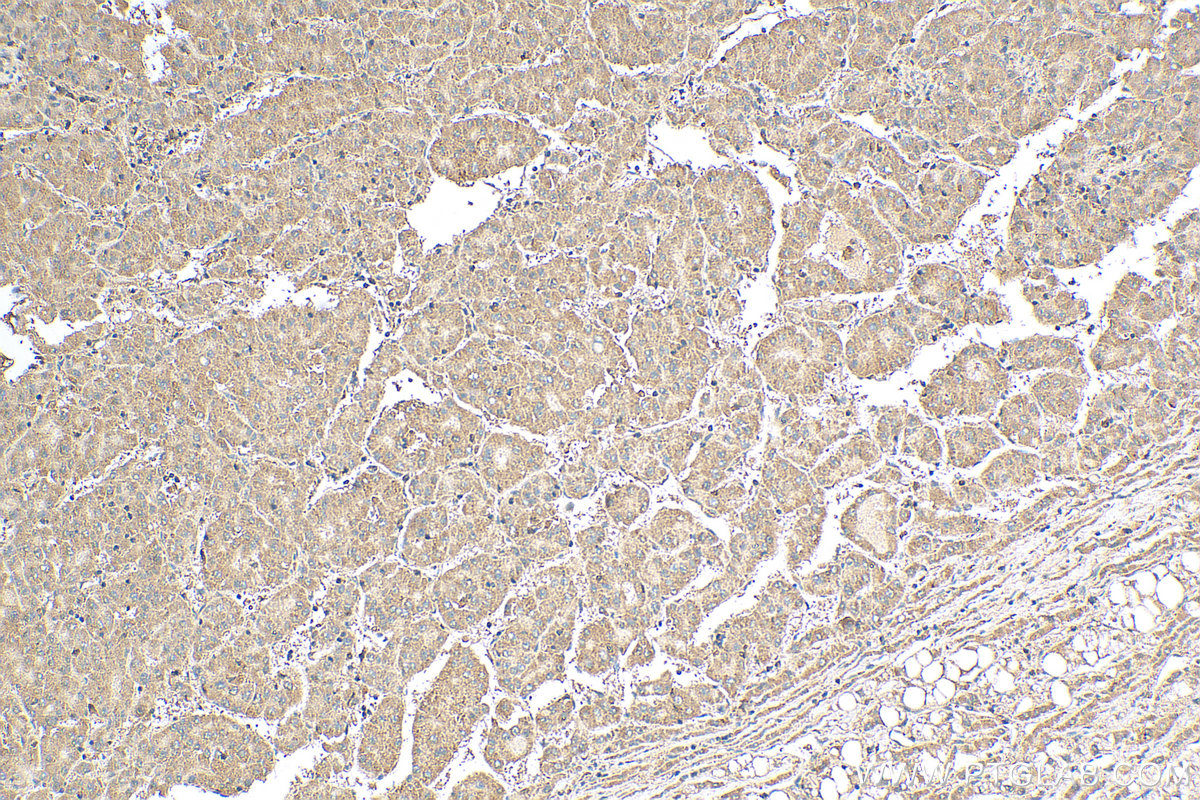 IHC staining of human liver cancer using 12225-1-AP