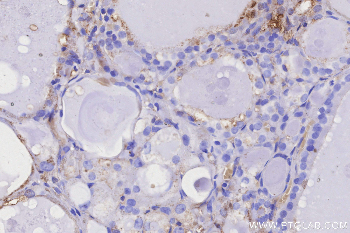 IHC staining of human thyroid cancer using 20502-1-AP IHC staining of human thyroid cancer using 20502-1-AP