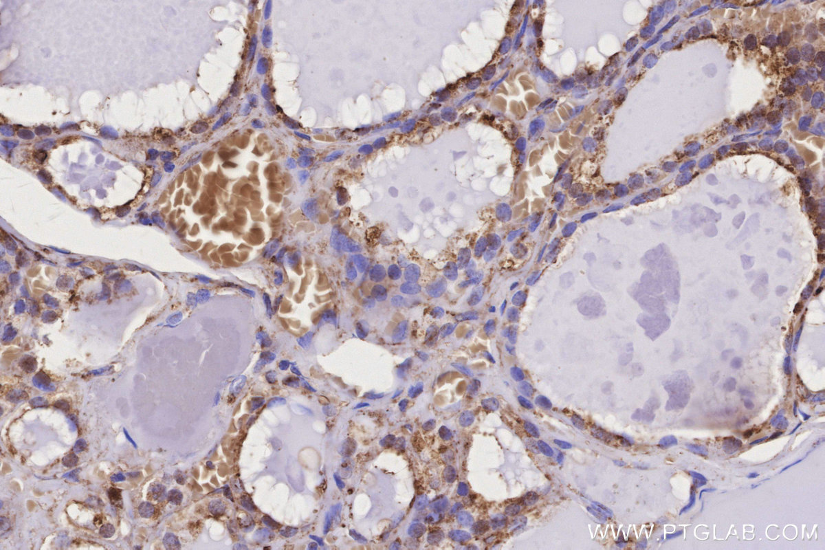 IHC staining of human thyroid cancer using 20502-1-AP IHC staining of human thyroid cancer using 20502-1-AP