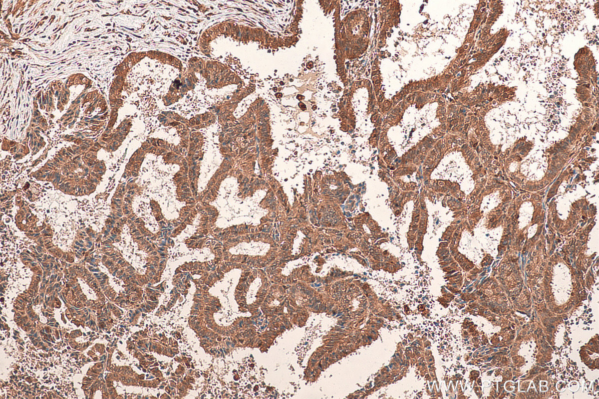 IHC staining of human ovary tumor using 82016-1-RR