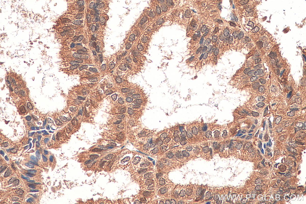 IHC staining of human ovary tumor using 82016-1-RR