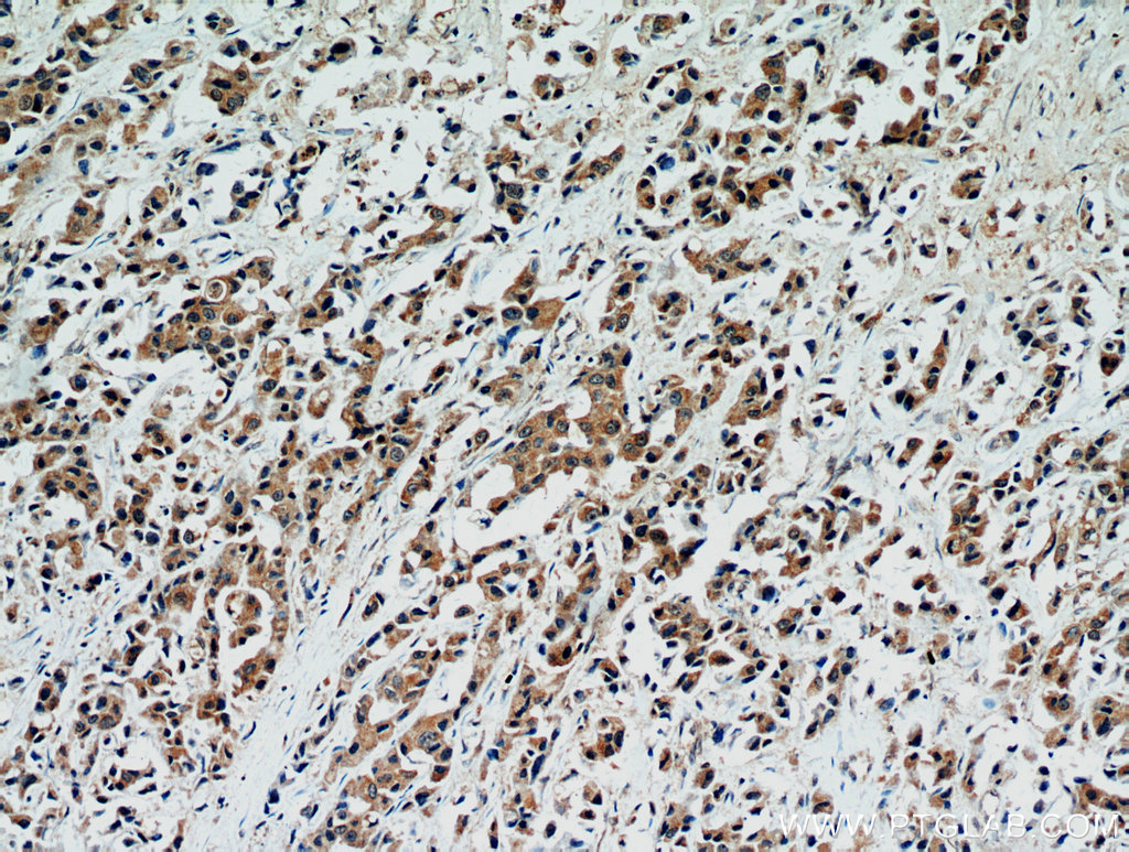 IHC staining of human breast cancer using 16674-1-AP