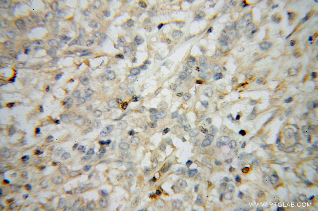 IHC staining of human breast cancer using 51075-2-AP