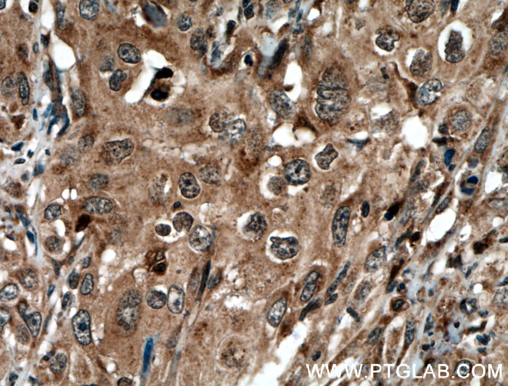 IHC staining of human cervical cancer using 51076-2-AP