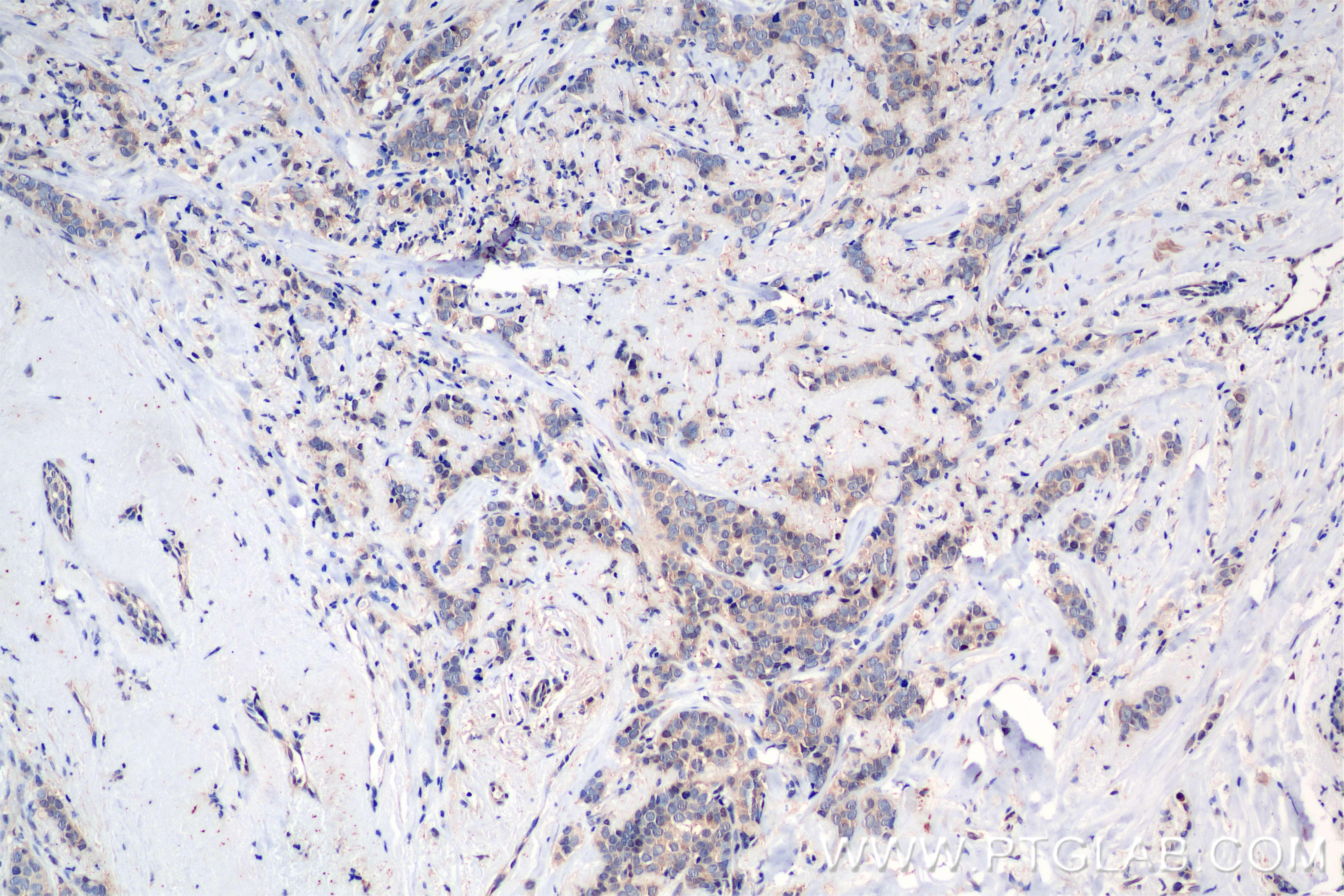 IHC staining of human breast cancer using 80149-1-RR (same clone as 80149-1-PBS)