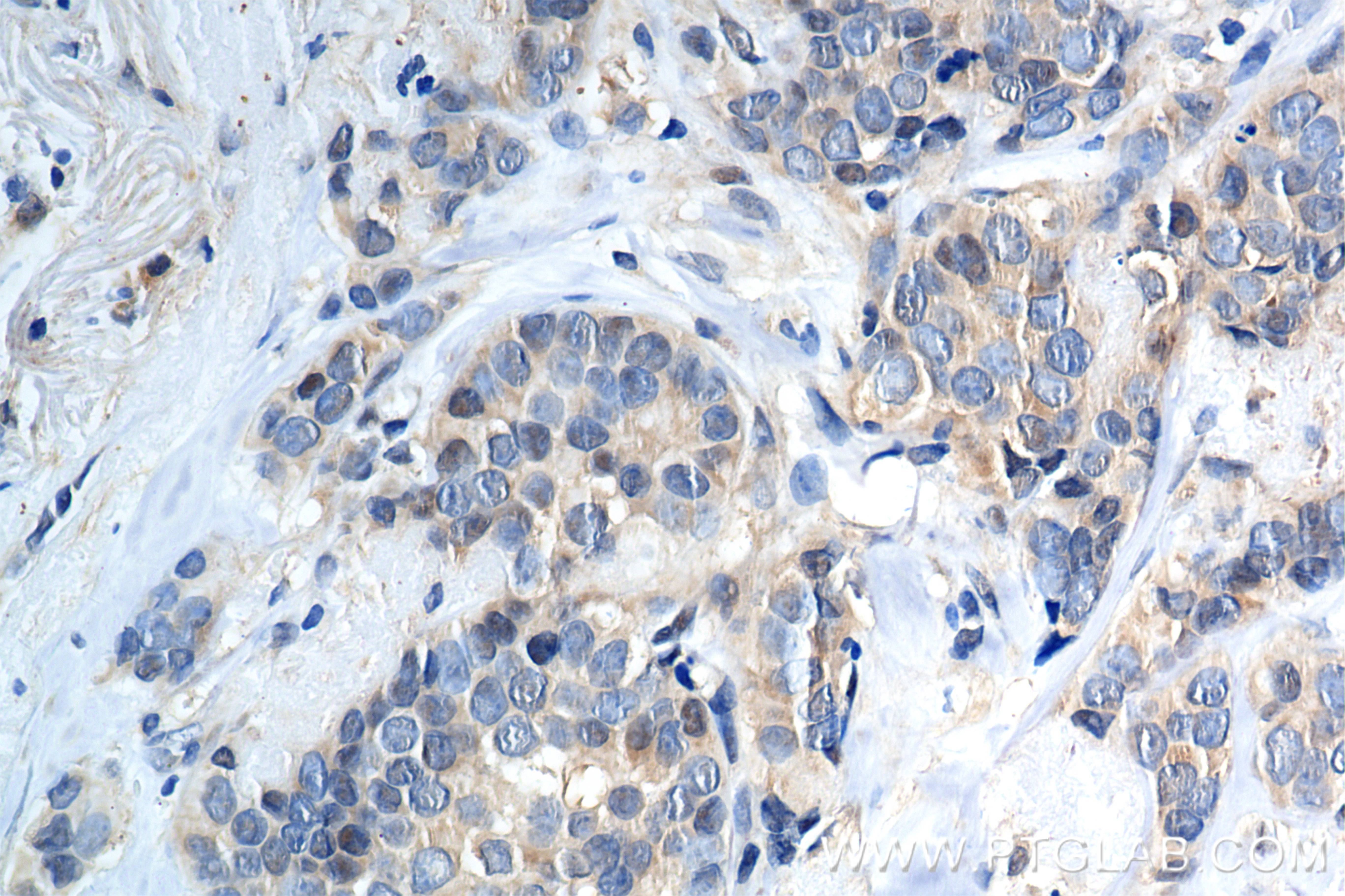 IHC staining of human breast cancer using 80149-1-RR (same clone as 80149-1-PBS)