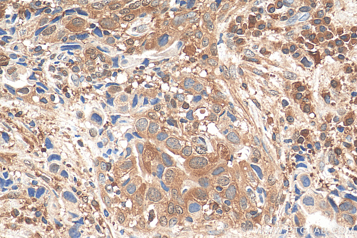 IHC staining of human breast cancer using 67568-2-Ig