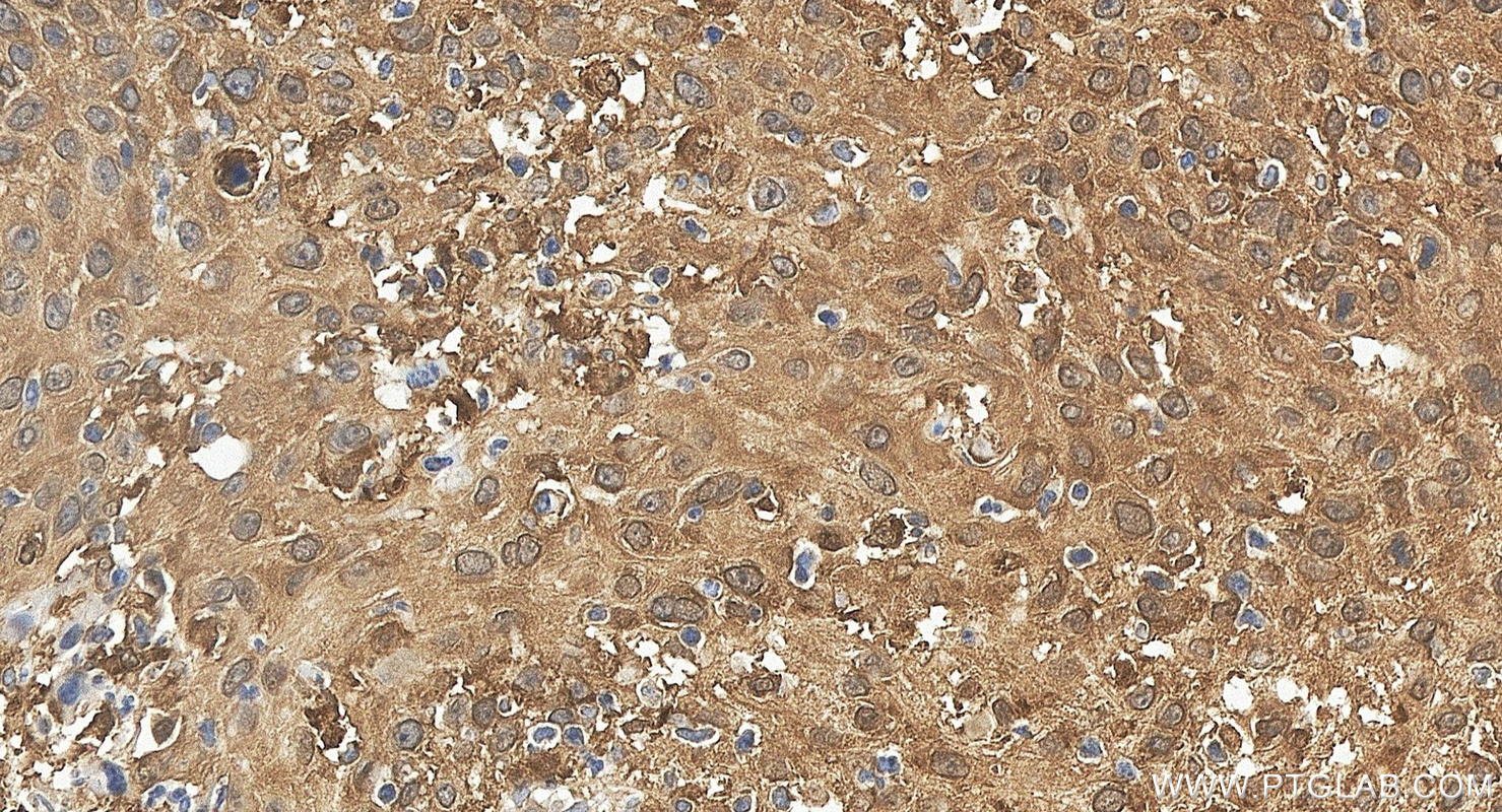IHC staining of human cervical cancer using 67568-2-Ig IHC staining of human cervical cancer using 67568-2-Ig