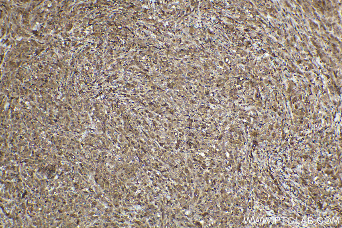 IHC staining of human lymphoma using 66459-1-Ig IHC staining of human lymphoma using 66459-1-Ig