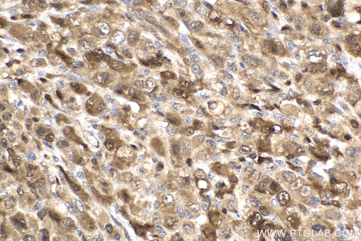 IHC staining of human lymphoma using 66459-1-Ig IHC staining of human lymphoma using 66459-1-Ig