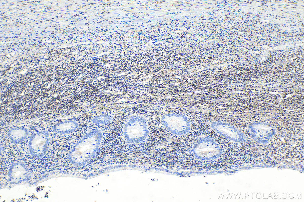 IHC staining of human appendicitis using 66717-1-Ig (same clone as 66717-1-PBS)