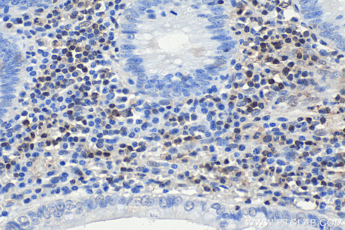 IHC staining of human appendicitis using 66717-1-Ig