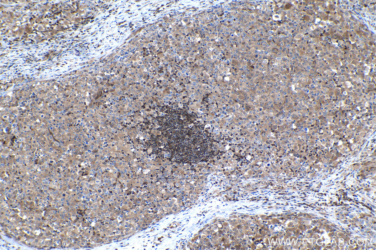 IHC staining of human lymphoma using 66717-1-Ig (same clone as 66717-1-PBS)