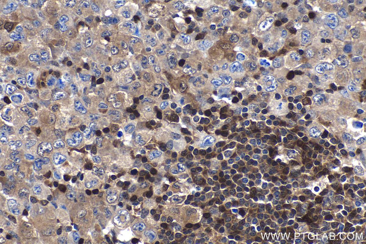 IHC staining of human lymphoma using 66717-1-Ig (same clone as 66717-1-PBS)