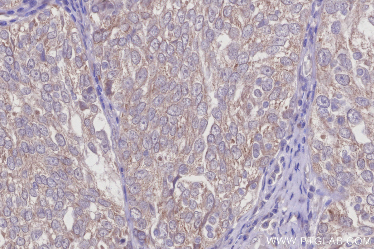 IHC staining of human ovary cancer using 15998-1-AP IHC staining of human ovary cancer using 15998-1-AP