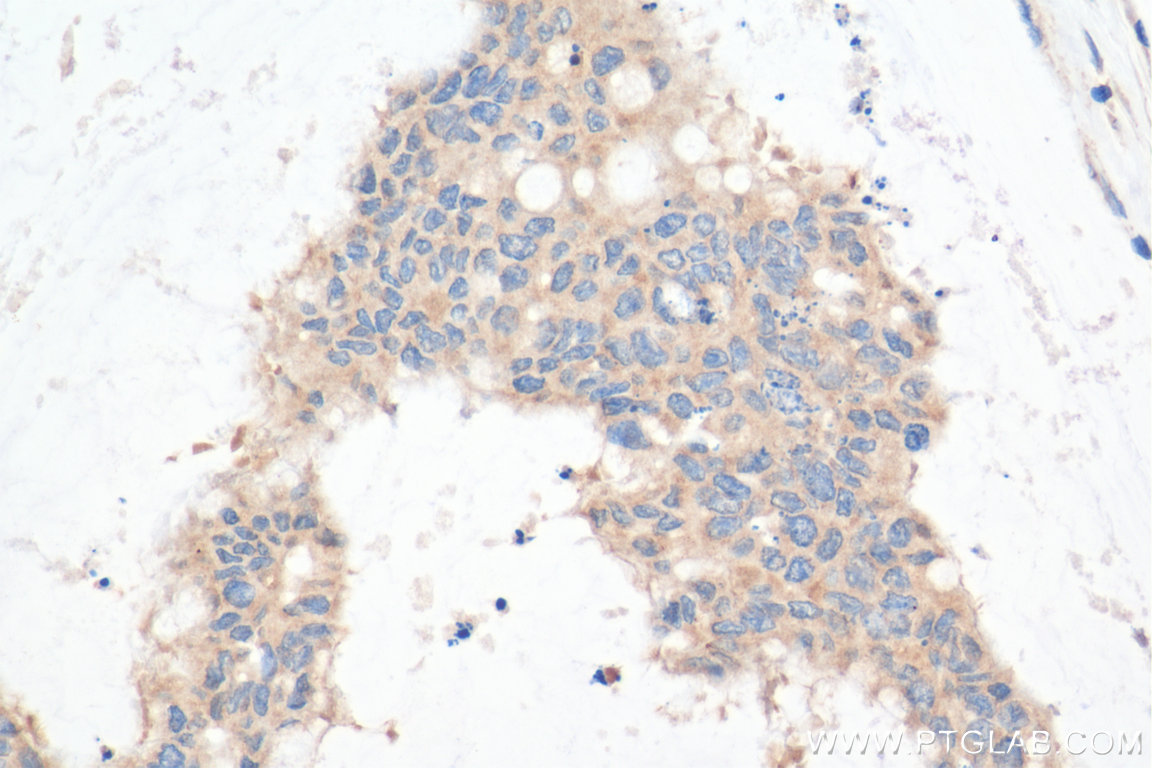 IHC staining of human colon cancer using 11842-1-AP