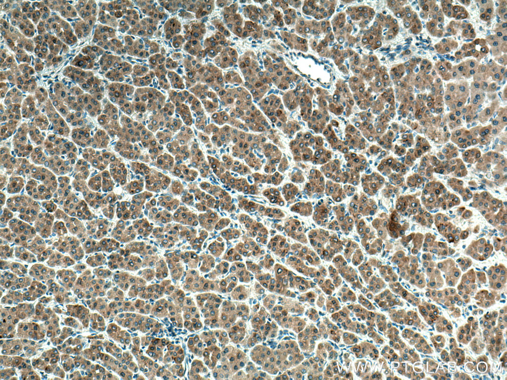 IHC staining of human liver cancer using 67018-1-Ig