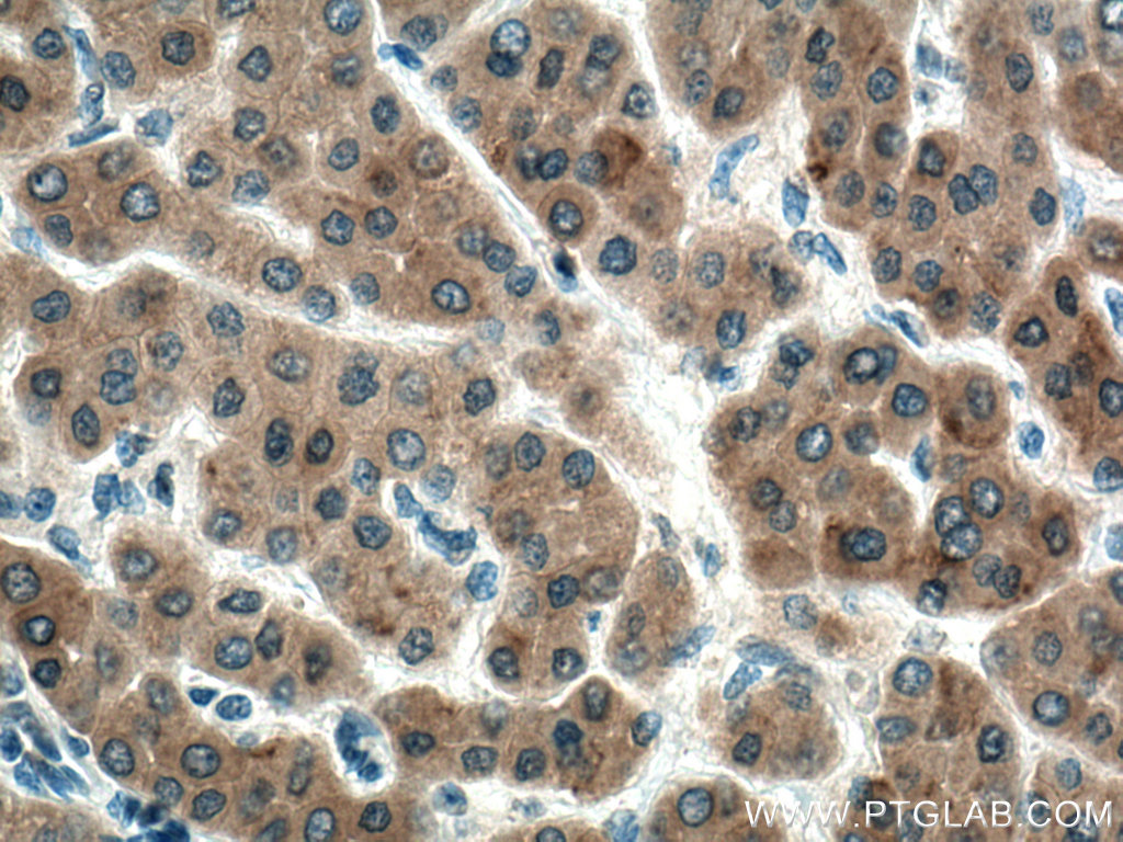 IHC staining of human liver cancer using 67018-1-Ig