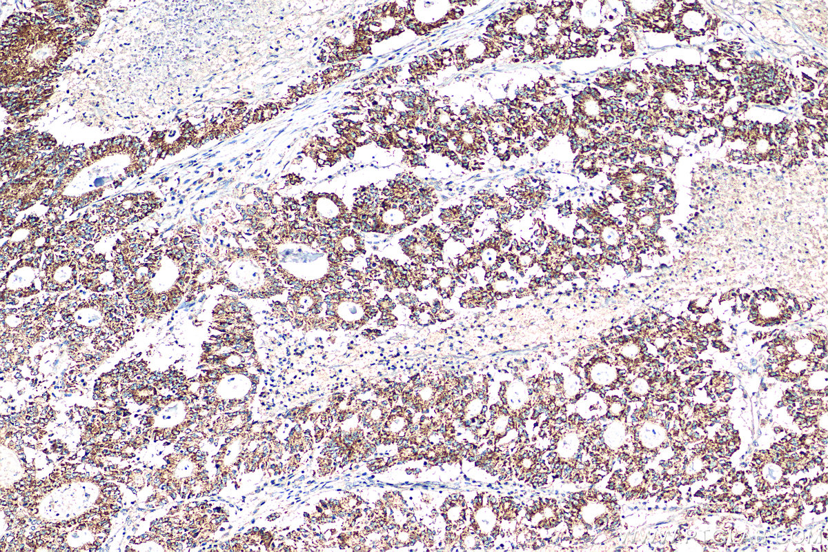 IHC staining of human colon cancer using 24804-1-AP