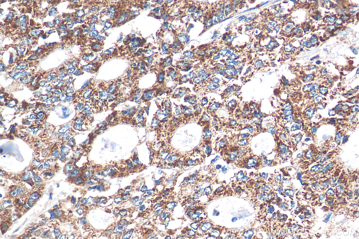 IHC staining of human colon cancer using 24804-1-AP