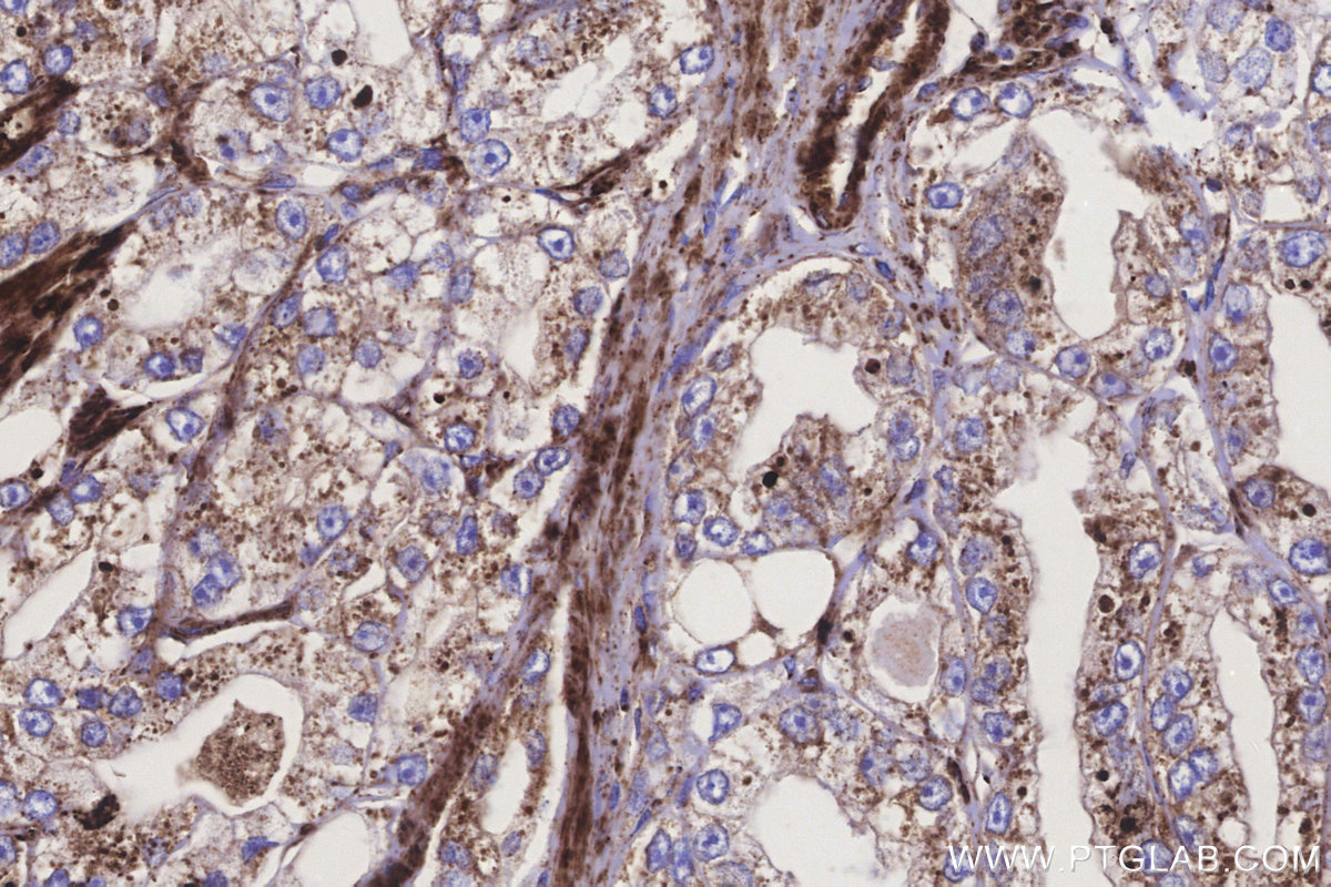 IHC staining of human prostate cancer using 83611-3-RR IHC staining of human prostate cancer using 83611-3-RR