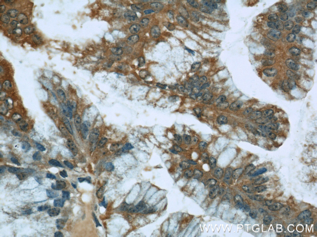 IHC staining of human ovary tumor using 11565-1-AP