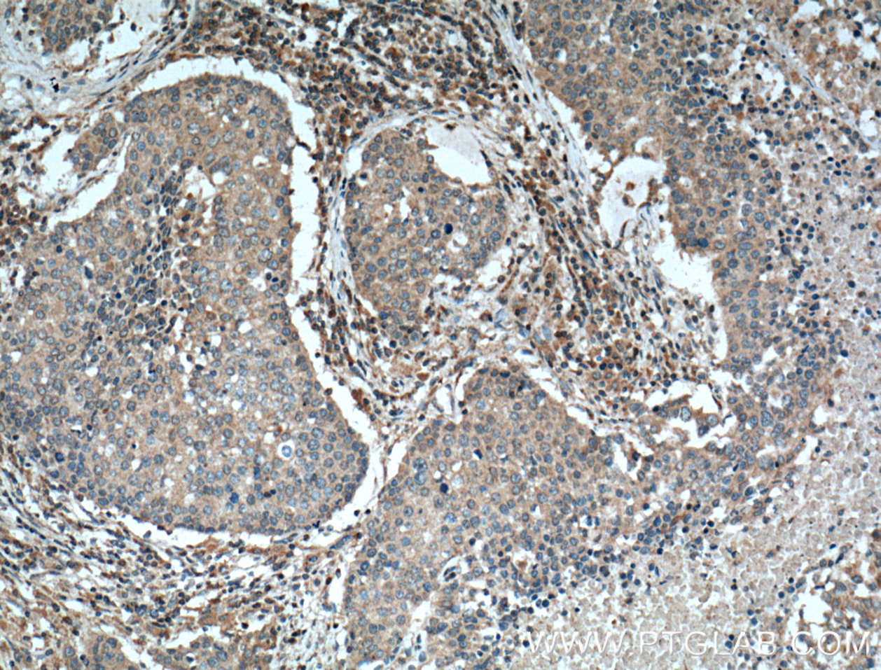 IHC staining of human lung cancer using 66189-1-Ig