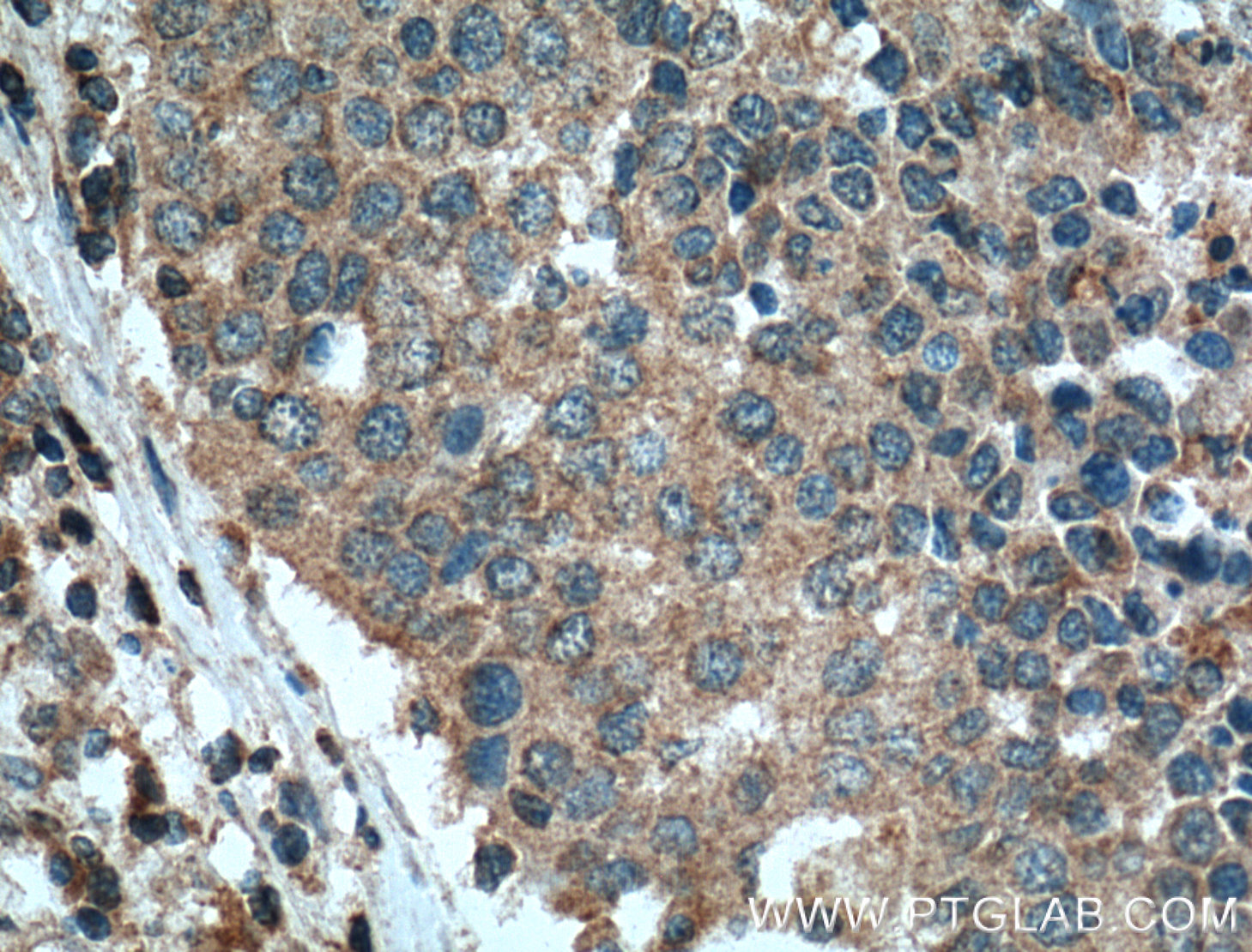 IHC staining of human lung cancer using 66189-1-Ig (same clone as 66189-1-PBS)