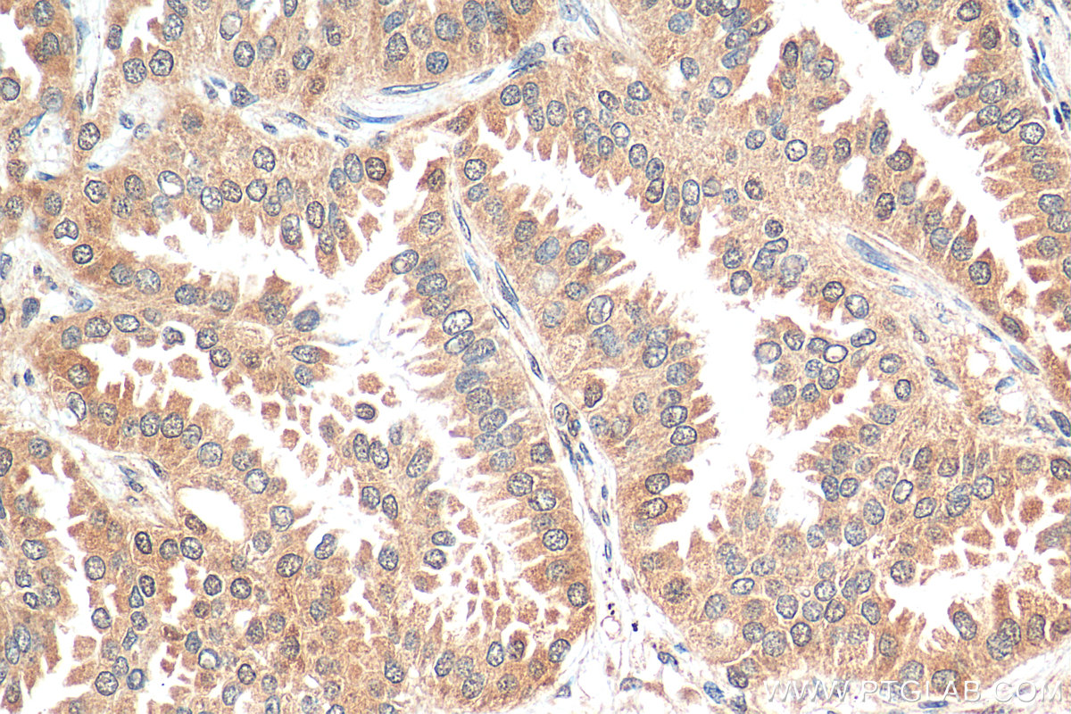 IHC staining of human lung cancer using 29323-1-AP
