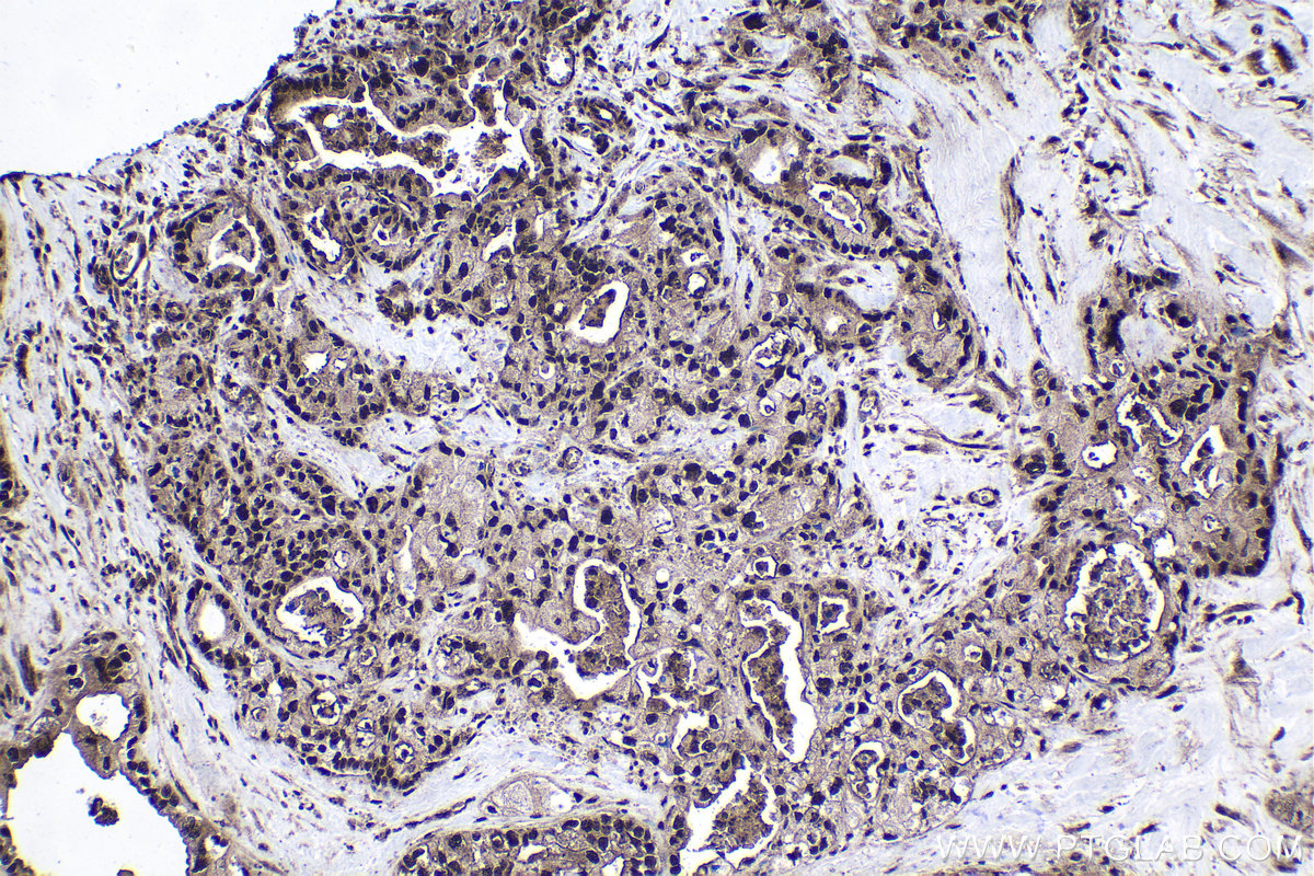 IHC staining of human pancreas cancer using 12097-1-AP