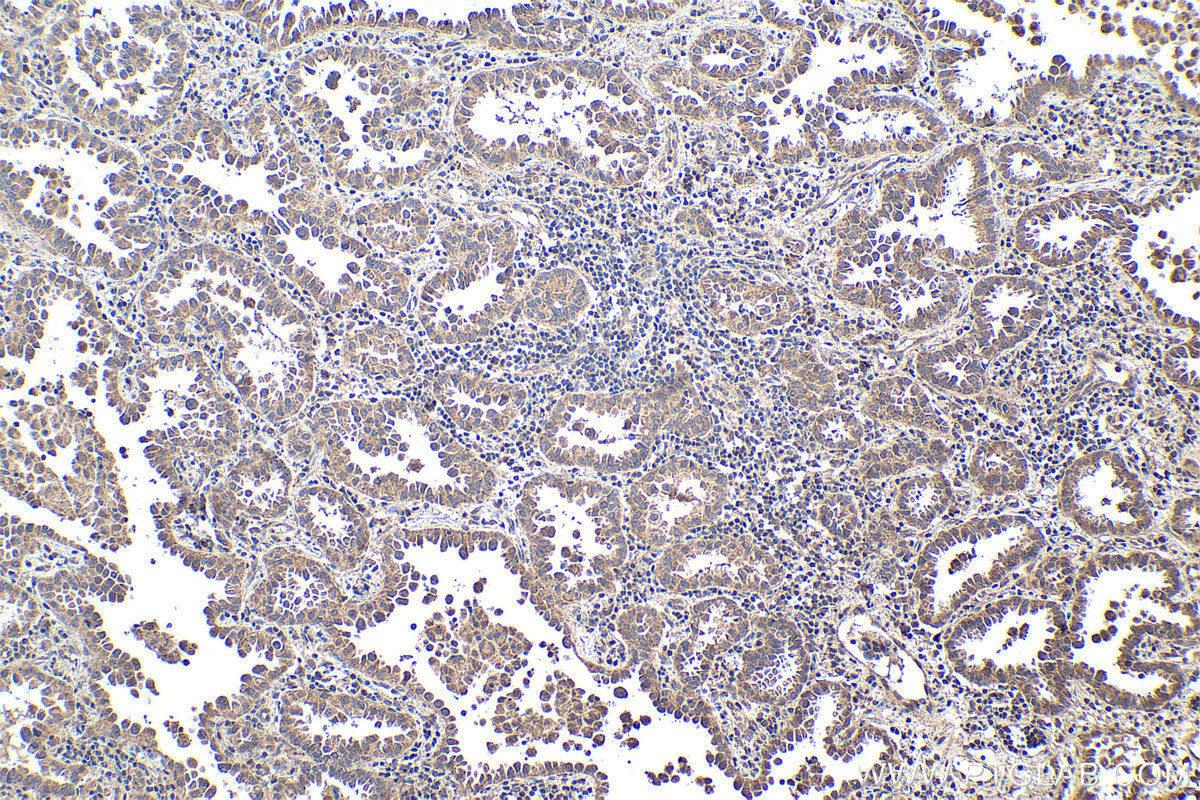 IHC staining of human lung cancer using 12559-1-AP (same clone as 12559-1-PBS)