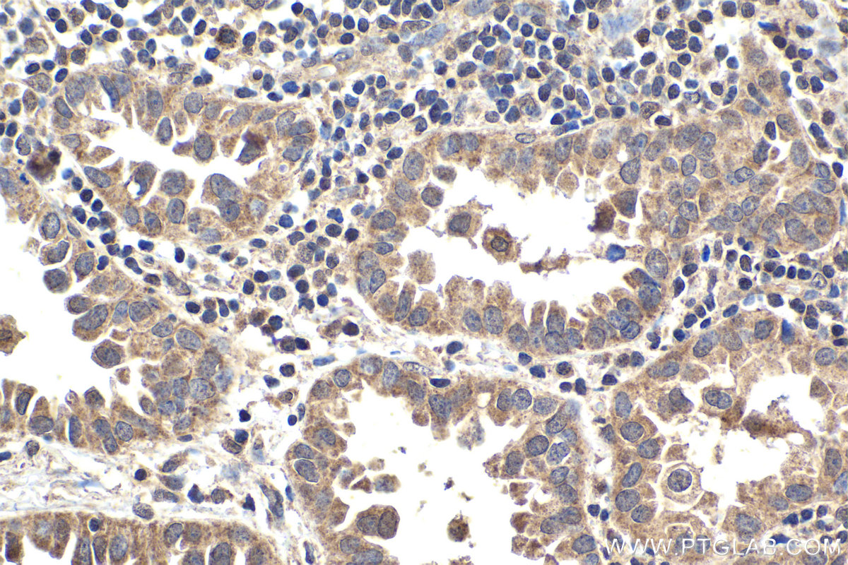 IHC staining of human lung cancer using 12559-1-AP (same clone as 12559-1-PBS)