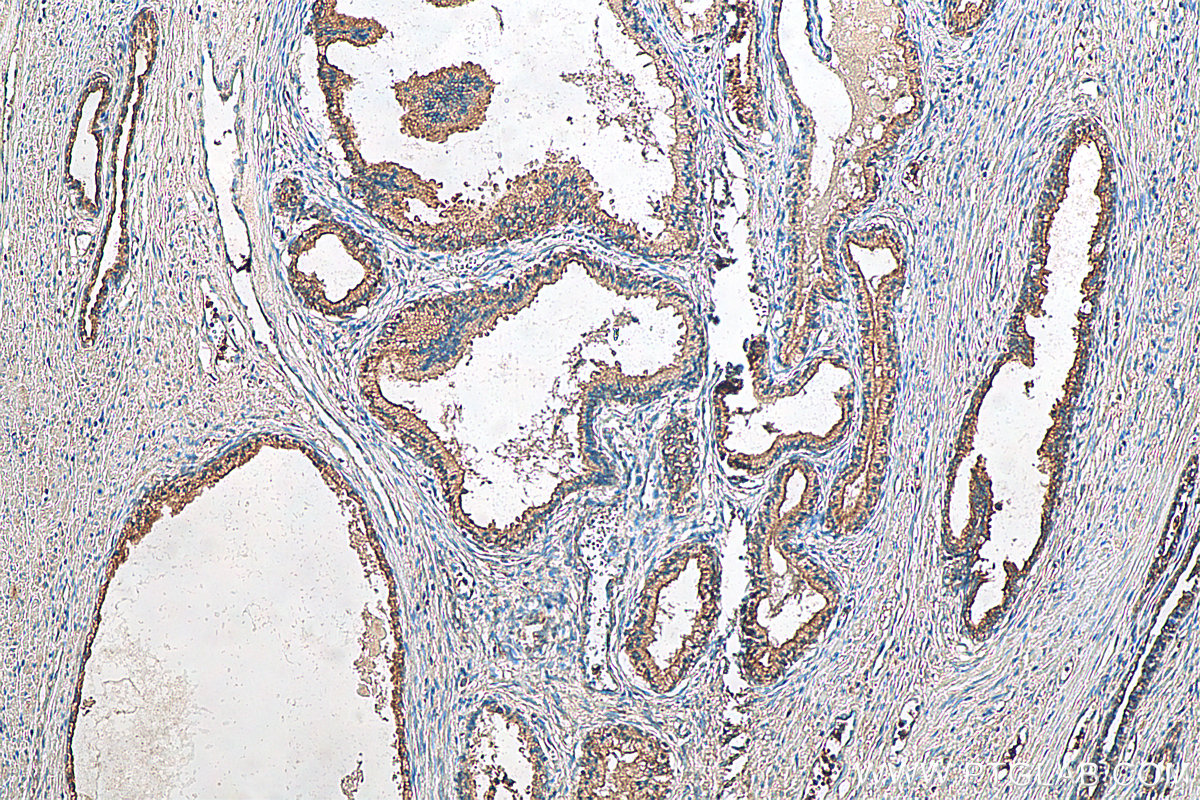 IHC staining of human prostate cancer using 22245-1-AP