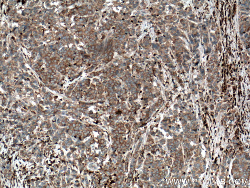 IHC staining of human prostate cancer using 66663-1-Ig