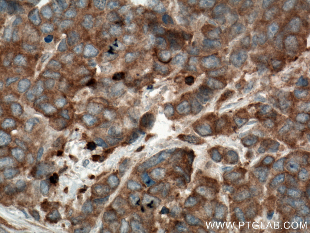 IHC staining of human prostate cancer using 66663-1-Ig